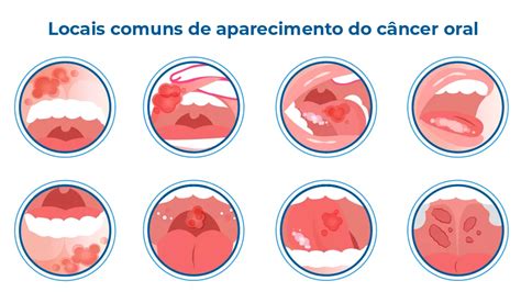 Tirar Pele Da Boca Traz Câncer