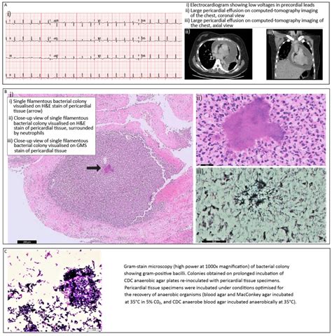 Pericardial Effusion And Tamponade In A Young Woman Annals Singapore