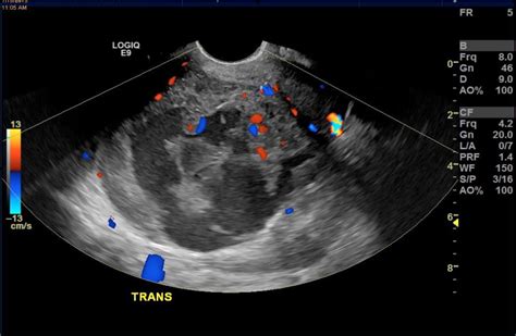 Beware Of A Multi‐fibroid Uterus The Importance Of Ultrasound Reporting In The Early Detection