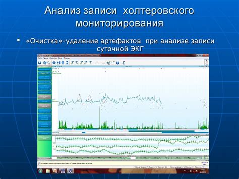 Холтеровское мониторирование ЭКГ в диагностике заболеваний сердца ...