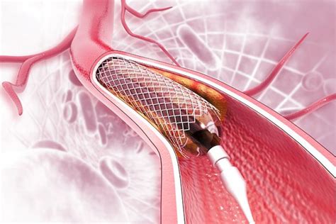 Qu Es Un Stent Cu Ntos Tipos Hay Y C Mo Es El Tratamiento