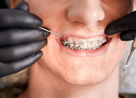 What To Do With Broken Braces Brackets West Windsor Ortho
