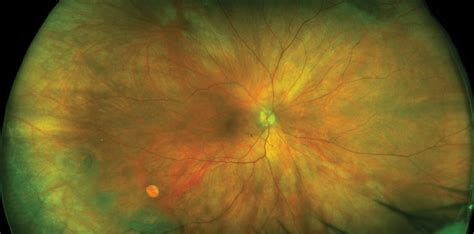 Crstg Europe Edition Use Of Uwf Retinal Imaging In Cataract Surgery