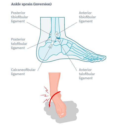 Ankle Lateral Ligament Injury Or Ankle Sprain Casues And Treatment