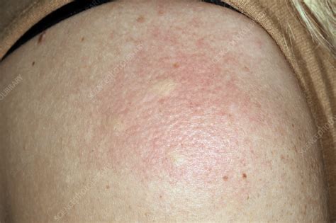 Spider Bite Allergic Reaction Rash