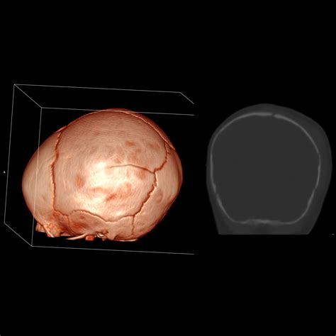 Pediatric Skull Fracture Pediatric Radiology Reference Article