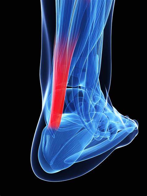 Achilles Tendon Injuries