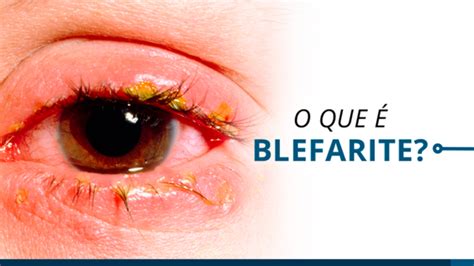 O Que Causa Blefarite - Blefarite. Quais As Causas, Os Sintomas E Qual O Tratamento? – ZHDWJA