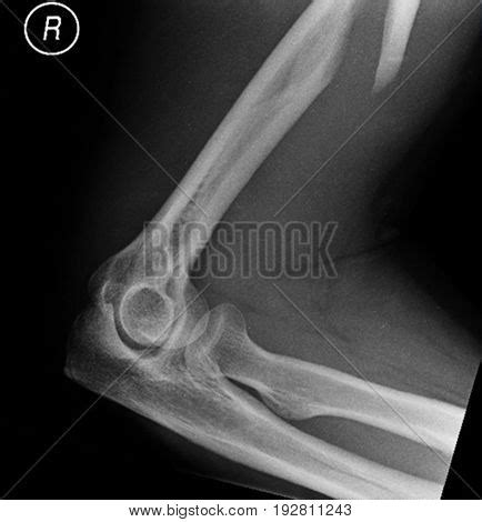 Broken Humerus X-ray Image & Photo (Free Trial) | Bigstock