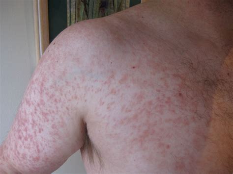 Measles Rash: Pictures, First Signs, How Long It Lasts