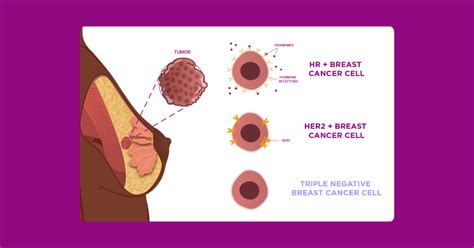 triple negative breast cancer symptoms risks  treatment