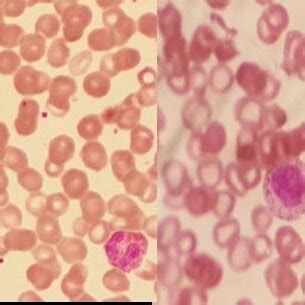 Peripheral Bloods Smear Analysis Showing Microcytotic Hypochromic Red