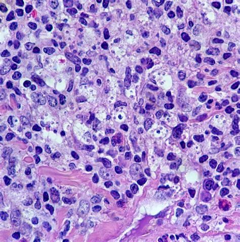 Pathology Outlines Leishmaniasis