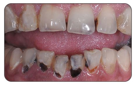 Rampant Caries In Adult Before And After 14 Months — Infinix™ Advanced