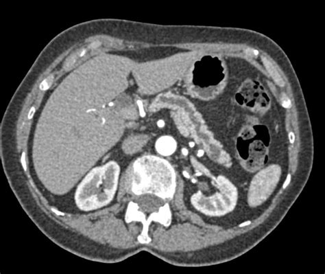Abdominal Ct Scan Pancreatic Cancer