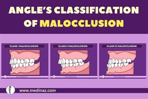 Angles Classification Malocclusion Dental Notes