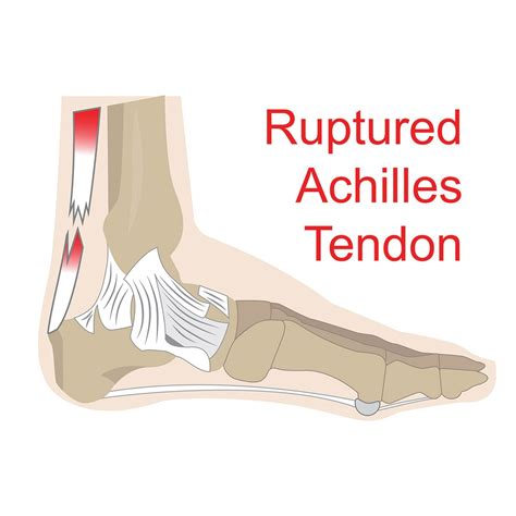 Achilles Rupture Surgical Versus Non Surgical Treatment Complete Physio