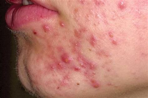 Differential Diagnoses Facial Rashes GPonline