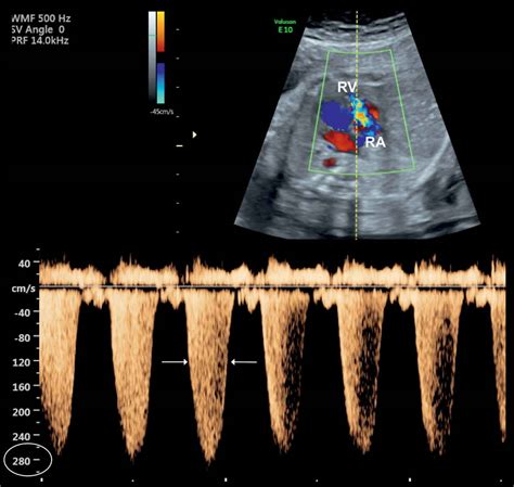 Ebstein Anomaly Tricuspid Valve Dysplasia And Tricuspid Regurgitation