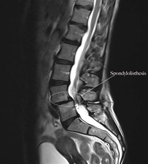 Spondylolisthesis Treatment | Bonati Spine Institute