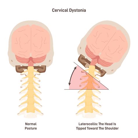 Cervical Dystonia And Spasmodic Torticollis Treatment