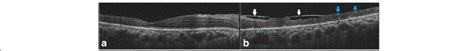 optical coherence tomography     eye showing  normal foveal