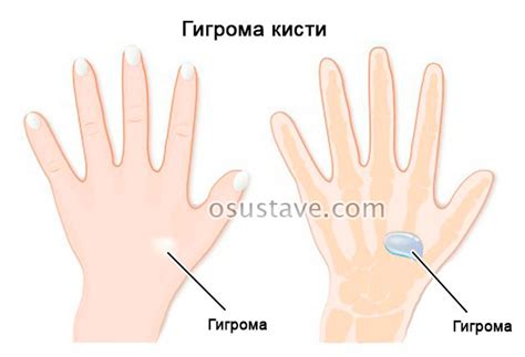 Гигрома кисти (на руке): причины, симптомы, диагностика, лечение