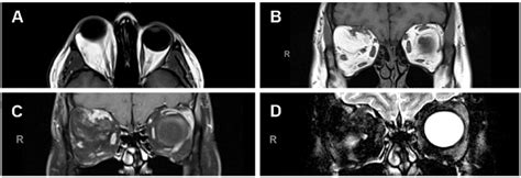 Mri Orbits With And Without Contrast From The First Presentation To Our