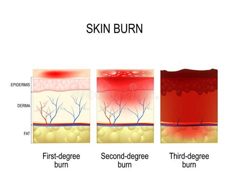 Skin Burn Three Degrees Of Burns Stock Vector Illustration Of Flame