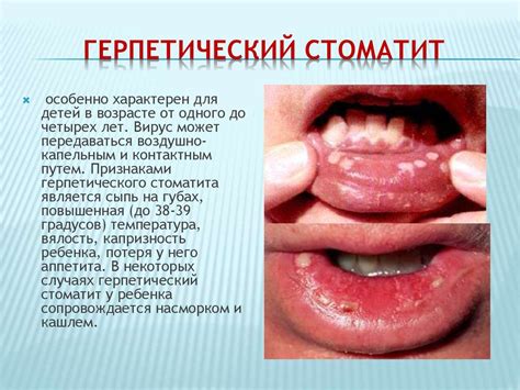 Стоматиты. Клиника, лечение - презентация онлайн