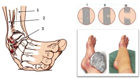 Tipos de esguinces y tiempo de recuperación de cada uno ICOPCV