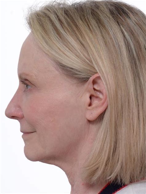 Before And After Profound Rf Marietta Facial Plastic Surgery