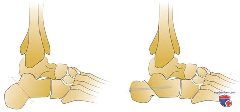 Причины патологически высокого продольного медиального свода стопы ...