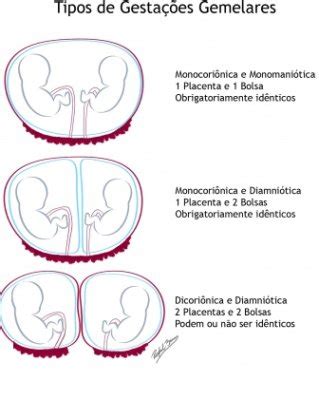 Gemeos De Placentas Diferentes Podem Ser Identicos - Sacos e placentas separadas podem ser idênticos! | BabyCenter