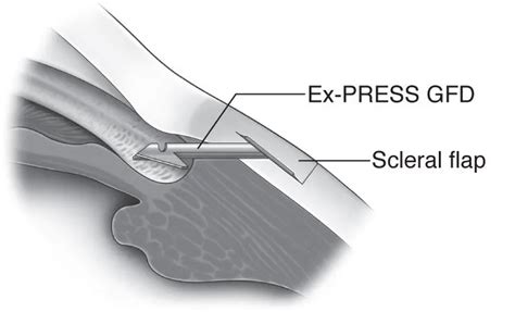 Express Shunt Glaucoma Information