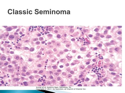 Ppt Testicular Neoplasms Powerpoint Presentation Free Download Id