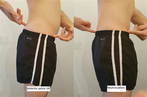 Anterior Pelvic Tilt Before And After