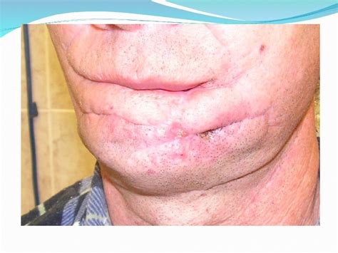 Рак губы. Заболеваемость - презентация онлайн