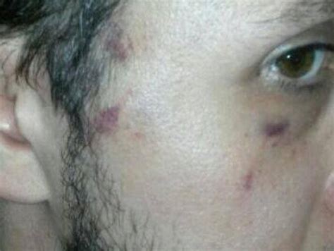 Artista Gay Pestato In DiscotecaGiallo Sulle Ragioni Dellaggressione Corriere It