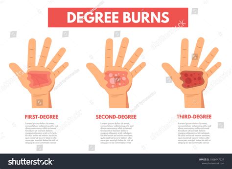 380 Second Degree Burn Images, Stock Photos & Vectors | Shutterstock