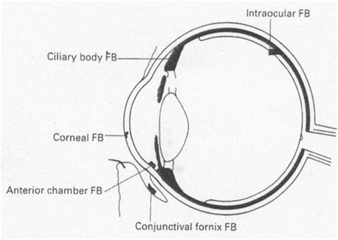 Ocular Trauma Flashcards Quizlet