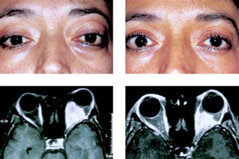 Stereotactic Irradiation Of Biopsy Proved Optic Nerve Sheath Meningioma