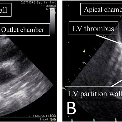 Preoperative Echocardiography A At Admission B 10 Days After