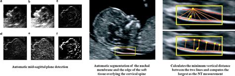 Frontiers | Artificial Intelligence in Obstetric Ultrasound: An Update ...