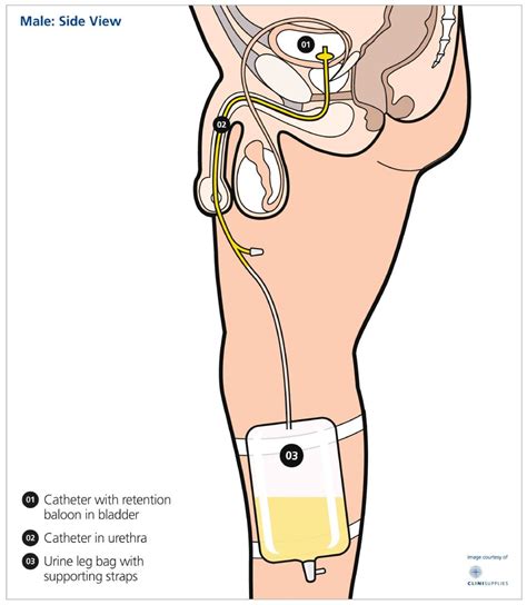 You And Your Catheter — Urology Associates