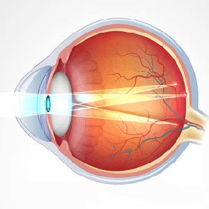 Астигматизм