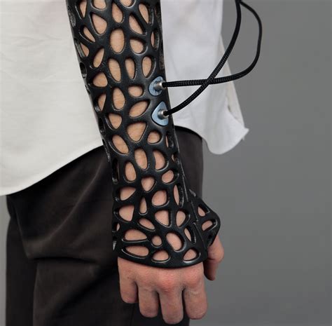 3D Printed Cast Heals Bones 40% Faster, Enables Ultrasound Treatment