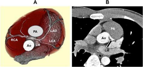 Usefulness Of Multidetector Ct Angiography For Anomalous Origin Of