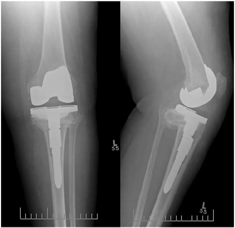 bilateral  union  high tibial osteotomies treated  total knee