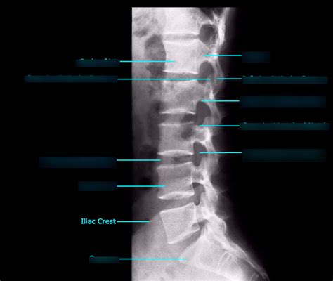 Lumbar Vertebra Lateral View